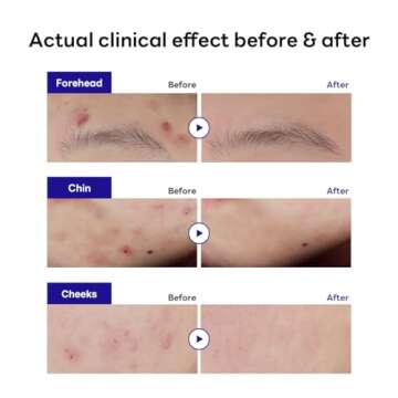 Mediheal Derma Clear Teatree Treatment Spot Patch (44 Counts) - Acne Relief, Oil and Moisture Balance with Teatree & Salicylic Acid