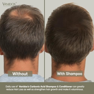 VANIDOX Carbonic Acid Shampoo with DHT Blockers