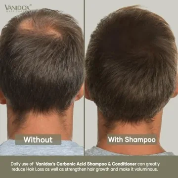 VANIDOX Carbonic Acid Shampoo with DHT Blockers