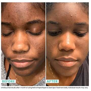 USRx® Retinol Rapid Repair Treatment, Fast-Absorbing, Targets Fine Lines, Hyperpigmentation, and Bl...