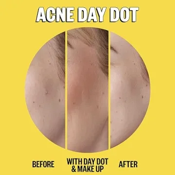 Peace Out Day and Night Acne Duo for Clear Skin