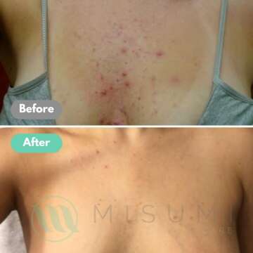 Misumi Acne Body Wash 120ml for Clear Skin & Bacne Treatment