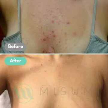 Misumi Acne Body Wash 120ml for Clear Skin & Bacne Treatment