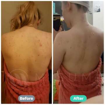 Misumi Acne Body Wash 120ml for Clear Skin & Bacne Treatment