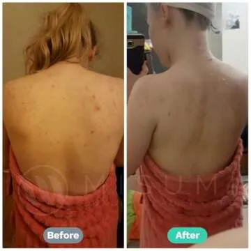 Misumi Acne Body Wash 120ml for Clear Skin & Bacne Treatment