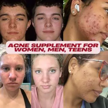 Acnetame Acne Pills- Vitamin Supplements for Acne Treatment- Natural Clear Skin from Hormonal Cystic...