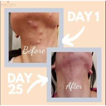 Clear Skin Supplement with Zinc for Adults, Formulated To Battle Hormonal Acne, Zinc Pills for Acne, Rosacea Skin Supplement, Zinc Supplements for Adult Acne - Anirva ClearDerm