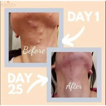 Clear Skin Supplement with Zinc for Adults, Formulated To Battle Hormonal Acne, Zinc Pills for Acne, Rosacea Skin Supplement, Zinc Supplements for Adult Acne - Anirva ClearDerm