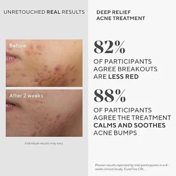 Murad Deep Relief Acne Treatment 1 Fl Oz