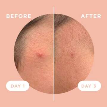 ZitSticka Killa Acne Patches - Fast-Acting Microdart Solution