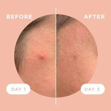 ZitSticka Killa Acne Patches - Fast-Acting Microdart Solution