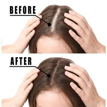 Hair Growth Serum, VOTALA Hair Growth Treatment, Anti Hair Loss, Promotes Thicker, Stronger Hair, And Hair Regrowth for Men Women