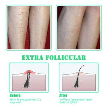 TailaiMei Exfoliating Brush for Ingrown Hair Treatment - To Treat and Prevent Bikini Bumps, Razor Bumps - Silky Smooth Skin Solution for Men and Women