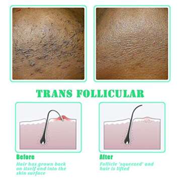 TailaiMei Exfoliating Brush for Ingrown Hair Treatment - To Treat and Prevent Bikini Bumps, Razor Bumps - Silky Smooth Skin Solution for Men and Women