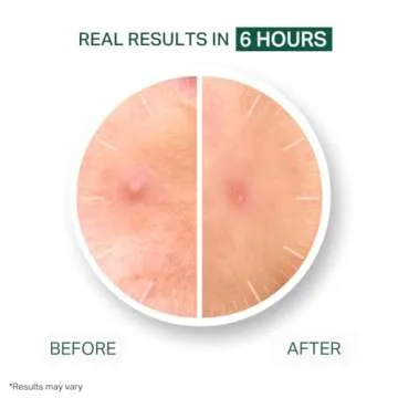 Y'OUR Hydrocolloid Acne Patches - 56 Count for Acne Healing