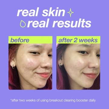 Breakout Clearing Booster for Acne Spot Treatment