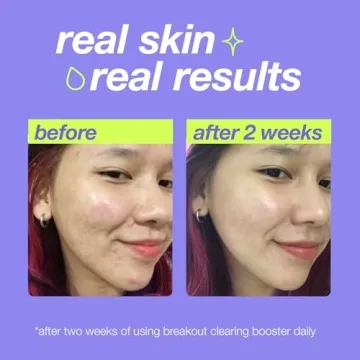 Breakout Clearing Booster for Acne Spot Treatment
