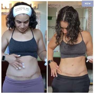 Dr. Zenovia Hormonal Dermatology Scar Gel Treatment