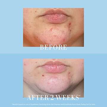 Kate Somerville Acne Mark Fading Gel - Maximum Strength Treatment