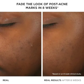 IT Cosmetics Acne Treatment Serum - Clear Skin Solution