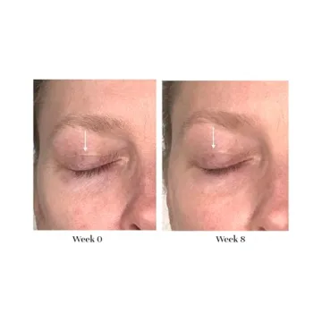 City Beauty Lid Lifting Treatment for Youthful Eyes