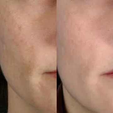 PMD Beauty Microderm Classic | Home Microdermabrasion Kit for Face | Exfoliating Crystals and Suction Help Circulation to Boost Collagen for Radiant Skin