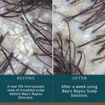 Bea’s Bayou Prebiotic Scalp Oil for Dry Itchy Scalp Relief - Promote Hair Growth, Soothe Itch, Sof...
