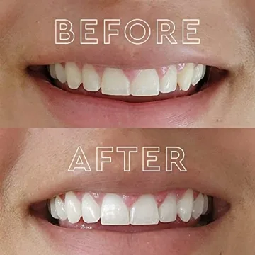 MOON Teeth Whitening Kit - Touch-Up in Just 5 Minutes!