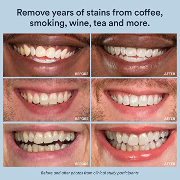 Auraglow LED Teeth Whitening Kit with 35% Carbamide Peroxide Gel