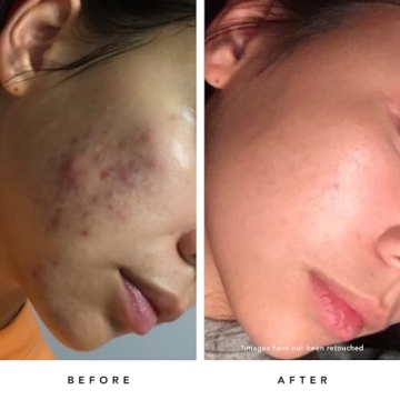 Herbivore Blue Tansy Resurfacing Mask for Clear Skin