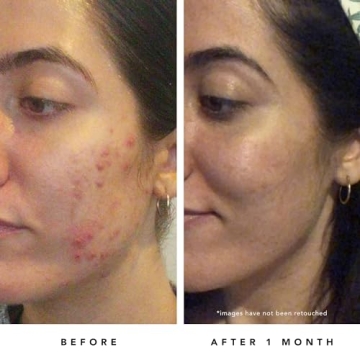 Herbivore Blue Tansy Resurfacing Mask for Clear Skin