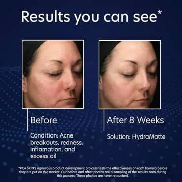 PCA SKIN HydraMatte Oil Control Moisturizer, Face Moisturizer for Oily Skin, Helps Reduce Oil and Promotes a Smoother Complexion, Absorbs Quickly, Great for Combination and Oily Skin, 1.8 oz Jar