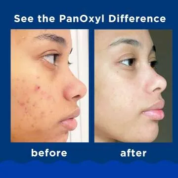PanOxyl Acne Foaming Wash 10% Benzoyl Peroxide 2 Pack