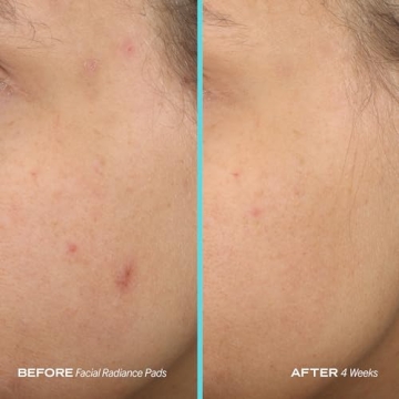 First Aid Beauty Facial Radiance Pads – Gentle Exfoliation