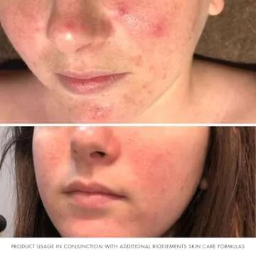 Bioelements Measured Micrograins Facial Scrub - Gentle Exfoliation