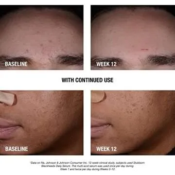 Neutrogena Stubborn Blackheads Acne Facial Serum for Clear Skin