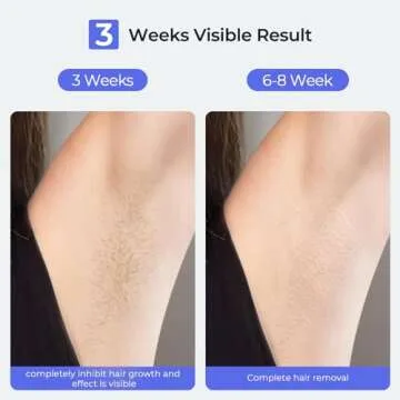 LUBEX Painless Sapphire Ice Cooling IPL Laser Hair Removal Device at Home for Women & Men, 1,000,000+ Unlimited Flashes, Safe and Permanent, Alternative to Salon Hair Removal for Face, Body, Bikini