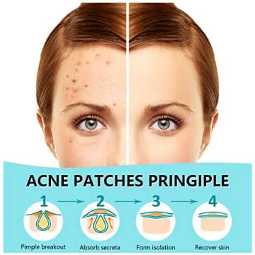 180 Counts Pimple Patches for Face Hydrocolloid Acne Patches for face Invisible Zit Patches for Face...