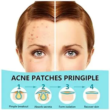 180 Counts Pimple Patches for Face Hydrocolloid Acne Patches for face Invisible Zit Patches for Face...