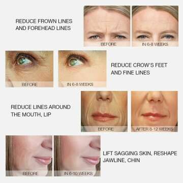 MLAY Radio Frequency Skin Tightening Machine