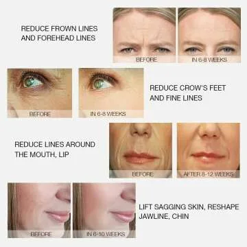 MLAY Radio Frequency Skin Tightening Machine