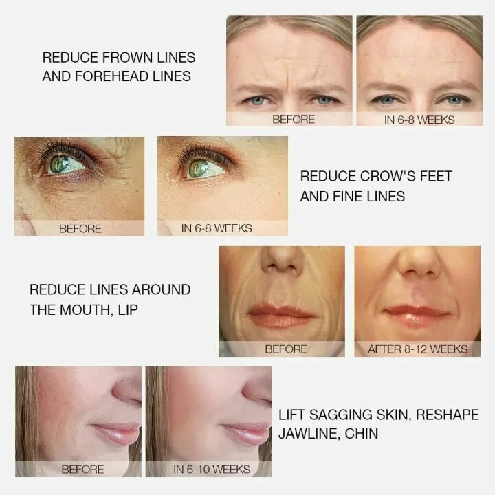 MLAY Radio Frequency Skin Tightening Machine