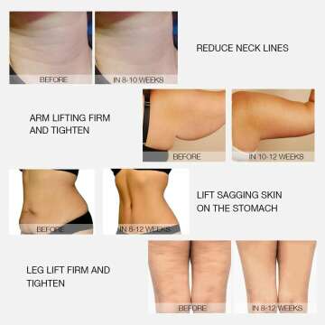 MLAY Radio Frequency Skin Tightening Machine