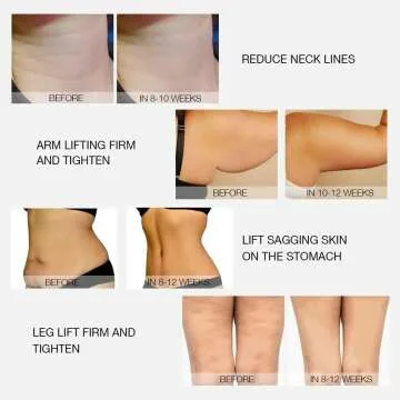 MLAY Radio Frequency Skin Tightening Machine