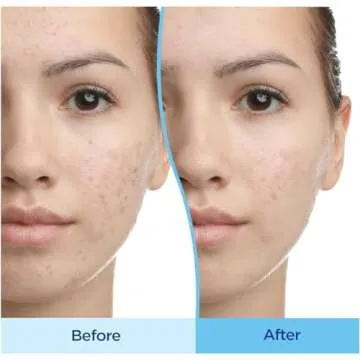 Differin 30 Day Gel & Night Moisturizer Set: Acne Treatement Gel (15g tube) & Restorative Night Moisturizer (2.5 oz), Gentle Skin Care for Acne Prone Skin, Fragrance Free, Mother's Day Gifts