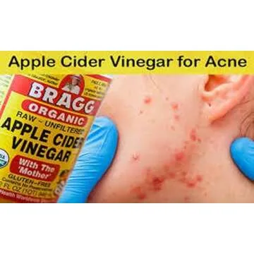 Apple Cider Vinegar: The Multifunctional Health Elixir with Treatment Benefits
