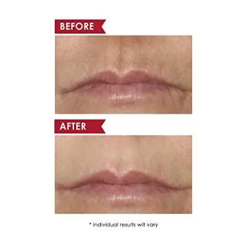 Dermelect Upper Lip Anti-Aging Treatment - 15ml