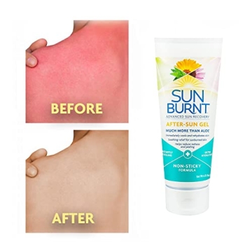 Hydrating Aloe Vera Gel for Sunburn Relief by Sunburnt