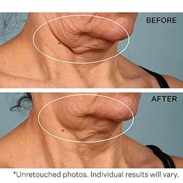 StriVectin TL Advanced Tightening Neck Cream PLUS, 1.7 Fl Oz Ã‚