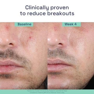 Cetaphil Gentle Clear Acne Cleanser 4.2oz